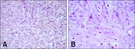 Malignant Mixed Tumor