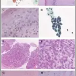 Malignant Neoplasms of the Vagina