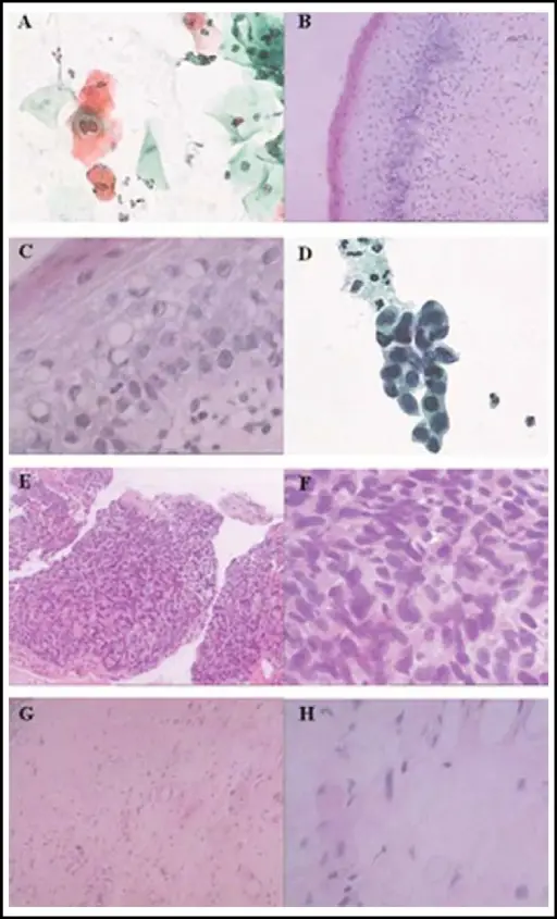 Malignant Neoplasms of the Vagina