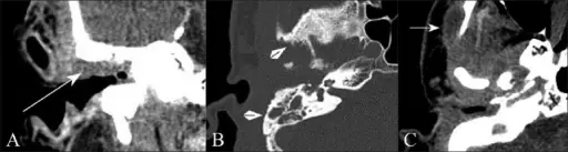 Malignant Otitis Externa