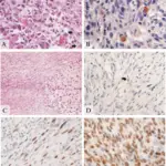 Malignant Peripheral Nerve Sheath Tumor