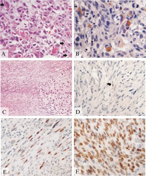 Malignant Peripheral Nerve Sheath Tumor