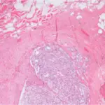 Malignant Skeletal Muscle Soft Tissue Tumors