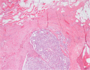 Malignant Skeletal Muscle Soft Tissue Tumors