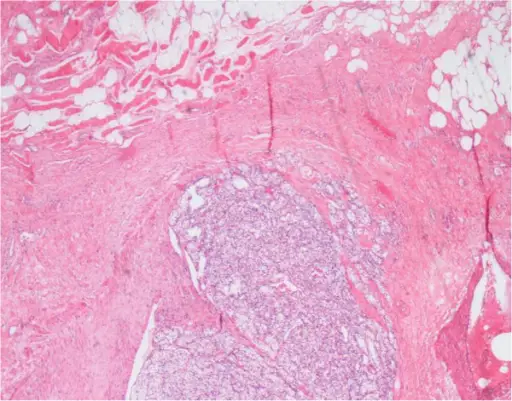 Malignant Skeletal Muscle Soft Tissue Tumors