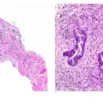 Malignant Skeletal Muscle Tumors