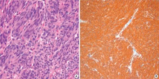 Malignant Smooth Muscle Soft Tissue Tumors