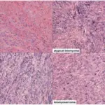 Malignant Smooth Muscle Tumors