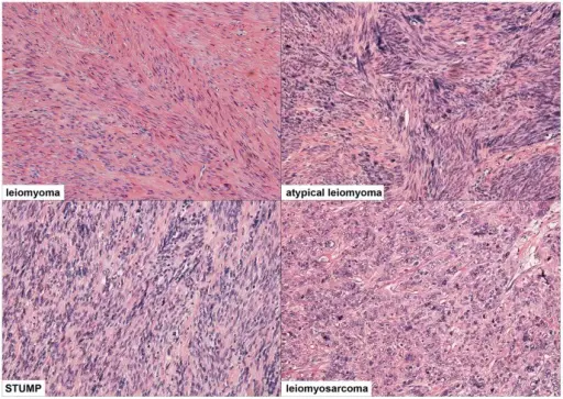 Malignant Smooth Muscle Tumors