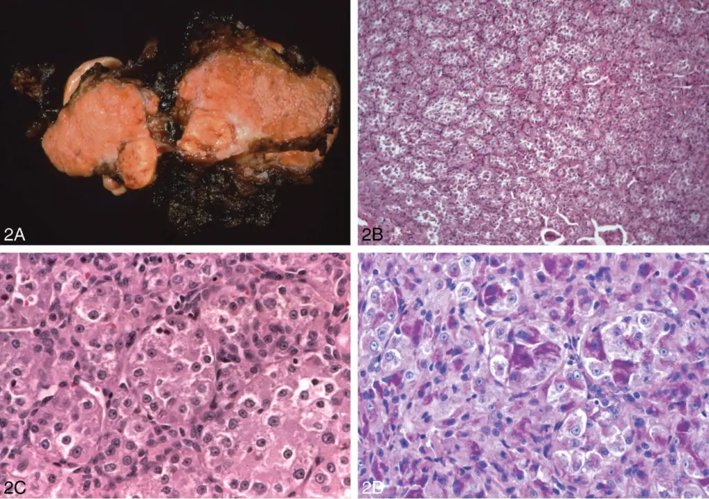 Malignant Soft Tissue Tumors of Uncertain Origin