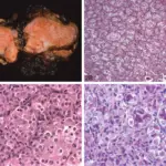 Malignant Soft Tissue Tumors of Uncertain Origin