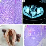 Malignant Tumors of the Endometrium