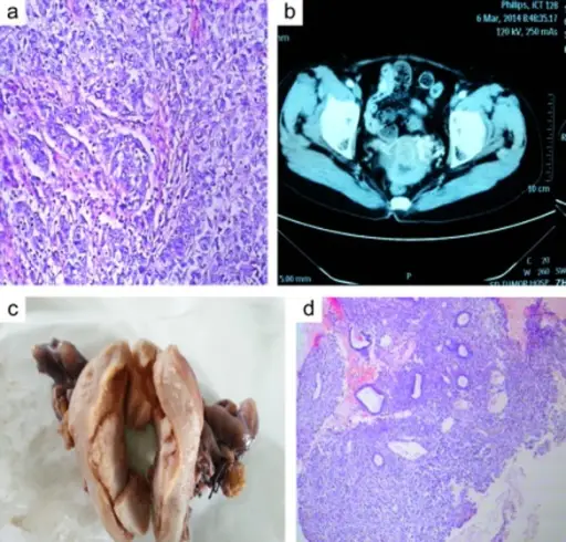 Malignant Tumors of the Endometrium