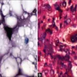 Malignant Vascular Soft Tissue Tumors