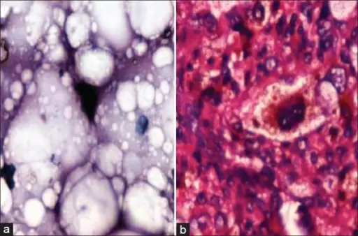 Malignant Vascular Soft Tissue Tumors