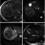 Malignant tumors of the vasculature