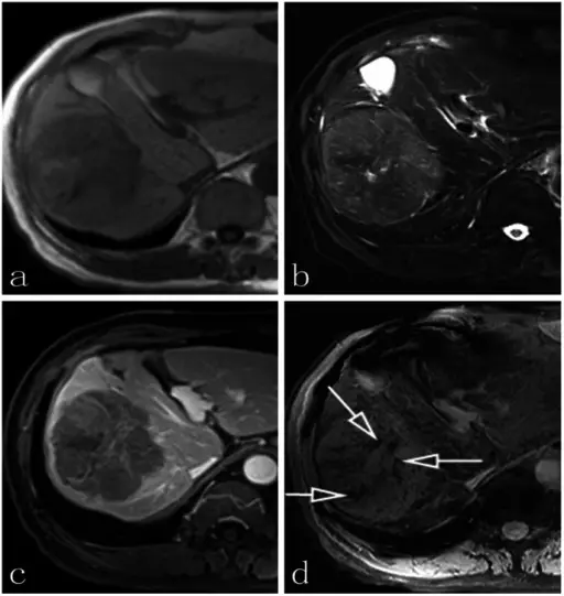 Malignant tumors of the vasculature