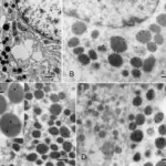 Mammosomatotroph Adenomas