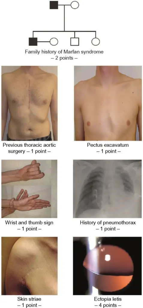 Marfan Syndrome