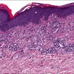 Mastocytosis