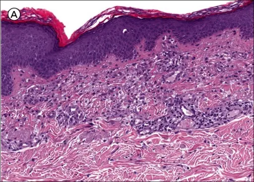 Mastocytosis