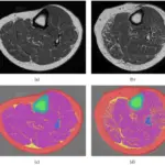 Maturity Onset Diabetes of the Young (MODY)