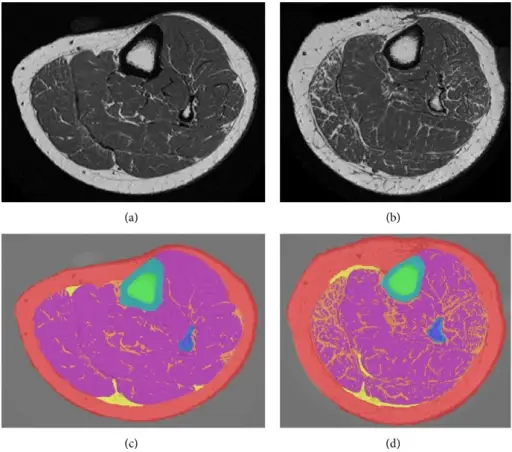 Maturity Onset Diabetes of the Young (MODY)