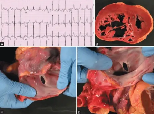 Mechanism of Death