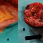 Meckel Diverticulum