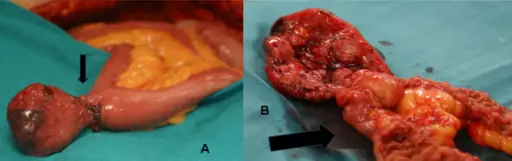 Meckel Diverticulum