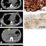 Mediastinal Tumors