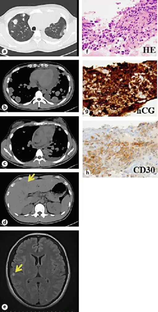 Mediastinal Tumors