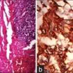 Medullary Carcinoma