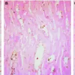 Medullary Sponge Kidney