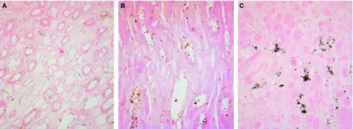 Medullary Sponge Kidney