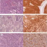 Medulloblastoma