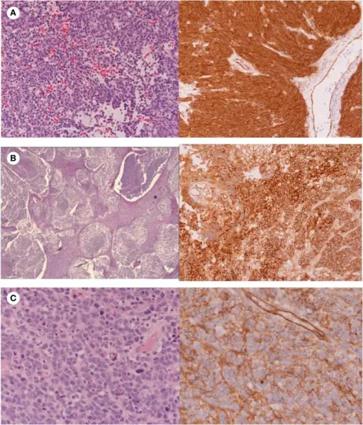 Medulloblastoma