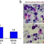 Megaloblastic Anemia