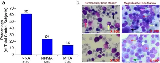 what-is-megaloblastic-anemia-pathosomes