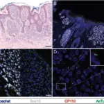 Melanocytic Nevi