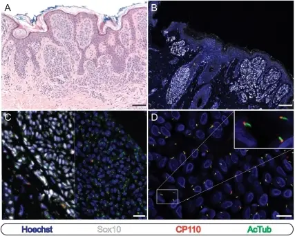 Melanocytic Nevi