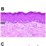 Melanoma