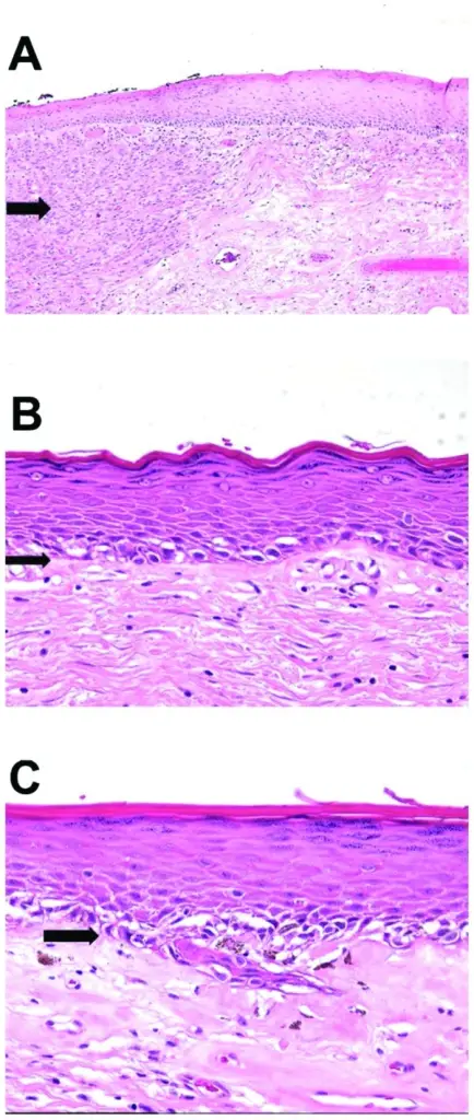 Melanoma