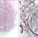 Membranoproliferative Glomerulonephritis