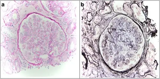 Membranoproliferative Glomerulonephritis