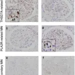 Membranous Nephropathy