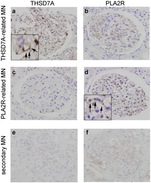 Membranous Nephropathy