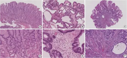 Menetrier Disease