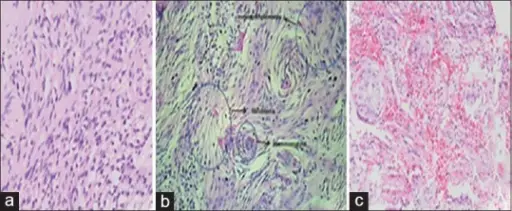 Meningiomas