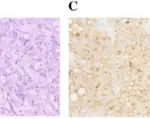 Mesotheliomas